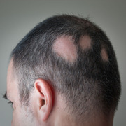 32af2367 img man alopecia hair 1050050000000000000000
